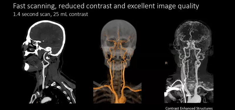 Система компьютерной томографии Philips Spectral CT 7500